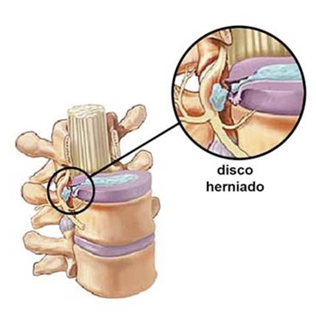 001-hernoia-dic-2-2015