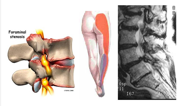 01-hernia-16-3-enero