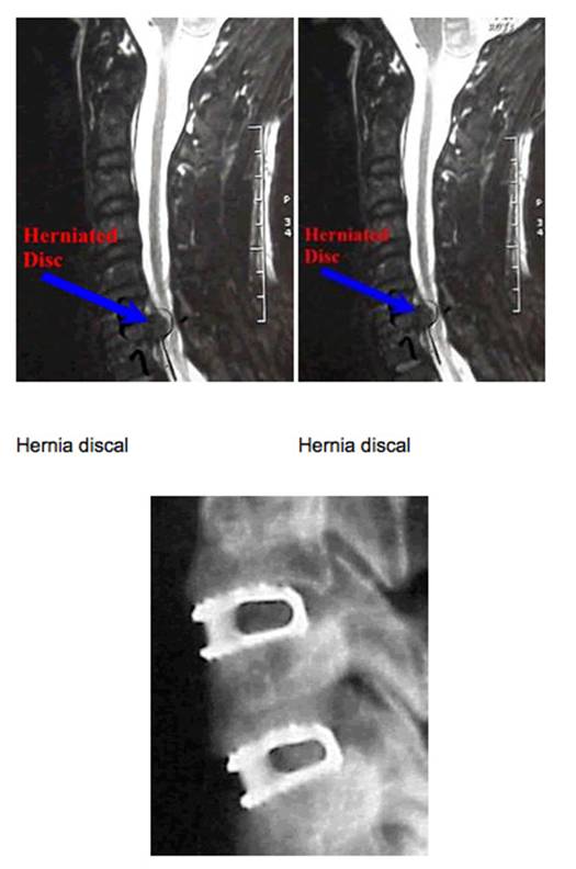 01-hernia-16-enero