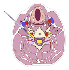 02-bloqueo-raquideo-nov-2015