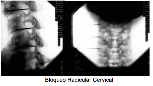 03-bloqueo-raquideo-nov-2015