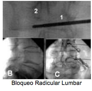 04-bloqueo-raquideo-nov-2015