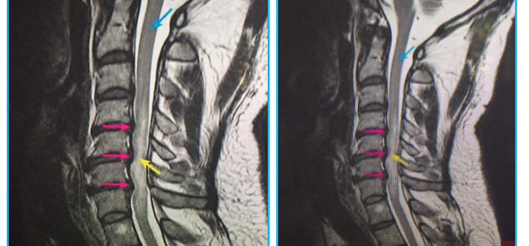 SÍNTOMAS DE MIELOPATÍAS CERVICAL