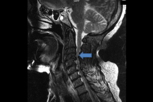 ¿QUÉ ES LA MIELOPATÍA CERVICAL ESPONDILÓTICA?