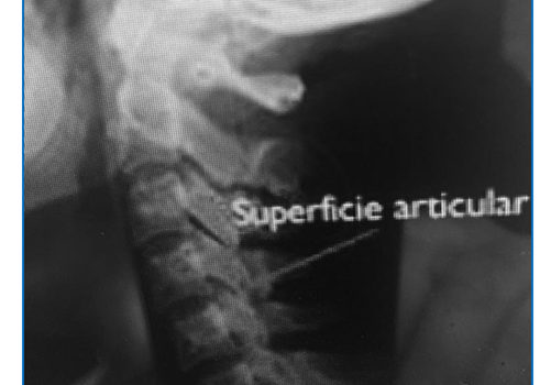 ESPONDILOSIS CERVICAL