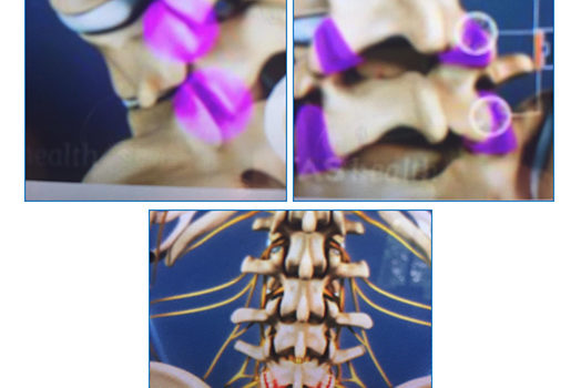 OSTEOARTRITIS DE LA COLUMNA VERTEBRAL