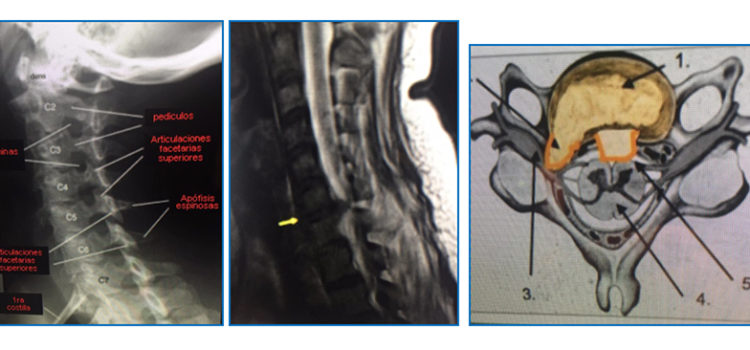 ARTROSIS CERVICAL